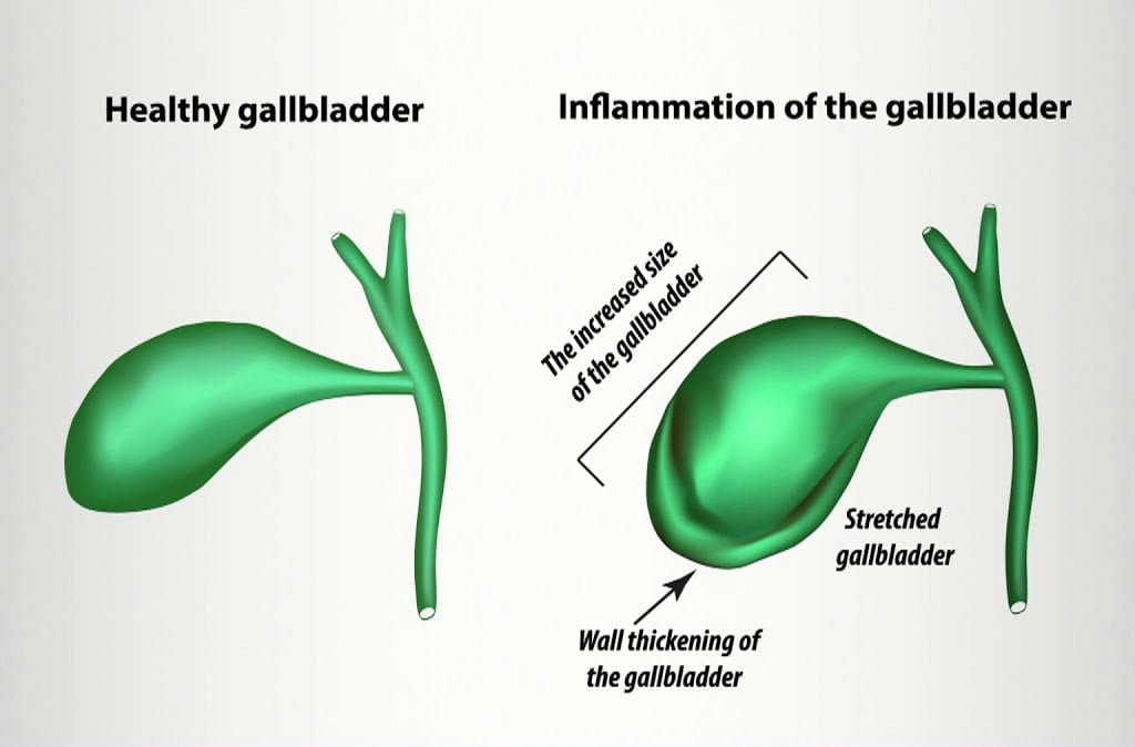 Gallbladder Problems