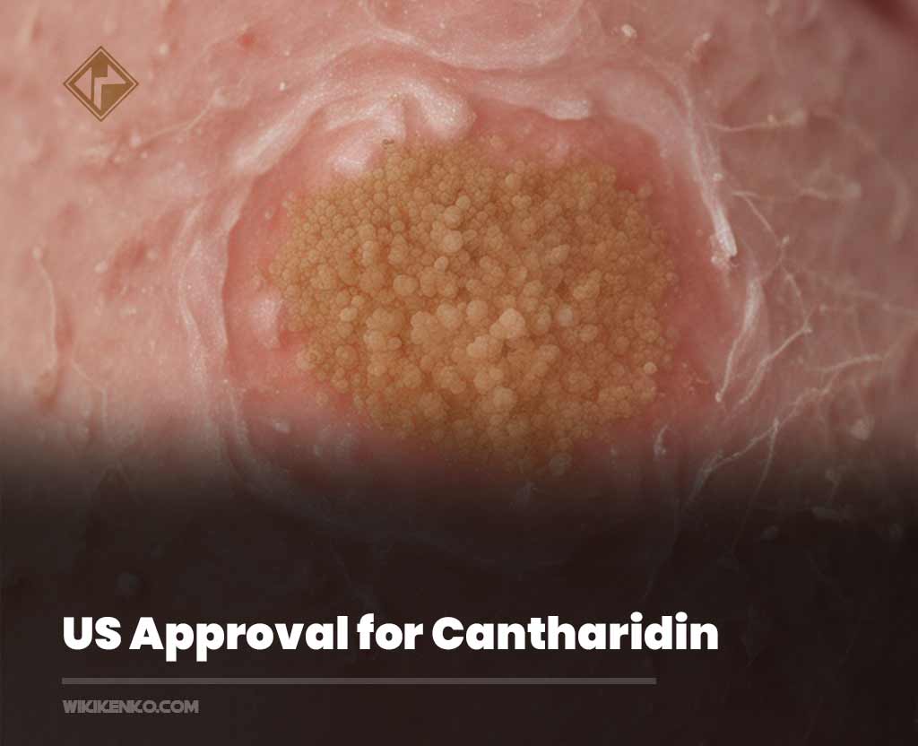 You are currently viewing US Approval for Cantharidin